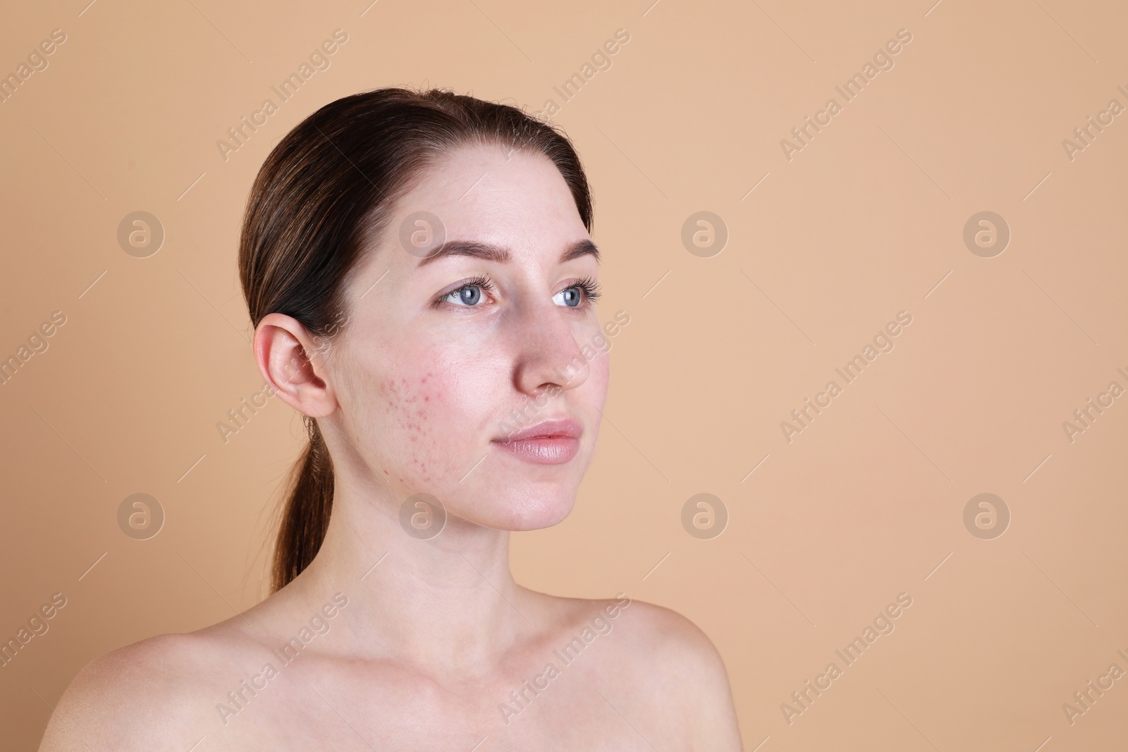 Photo of Young woman with acne problem on beige background. Space for text