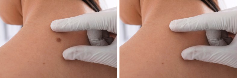 Image of Collage with photos of patient's back before and after mole removing procedure, closeup. Dermatologist checking woman's skin