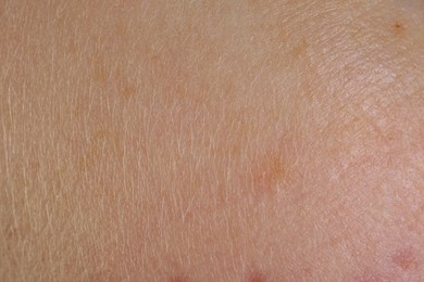 Photo of Texture of skin with birthmarks as background, macro view
