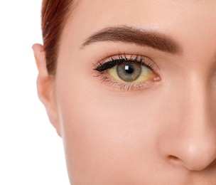 Photo of Woman with yellow eyes on white background, closeup. Symptom of hepatitis