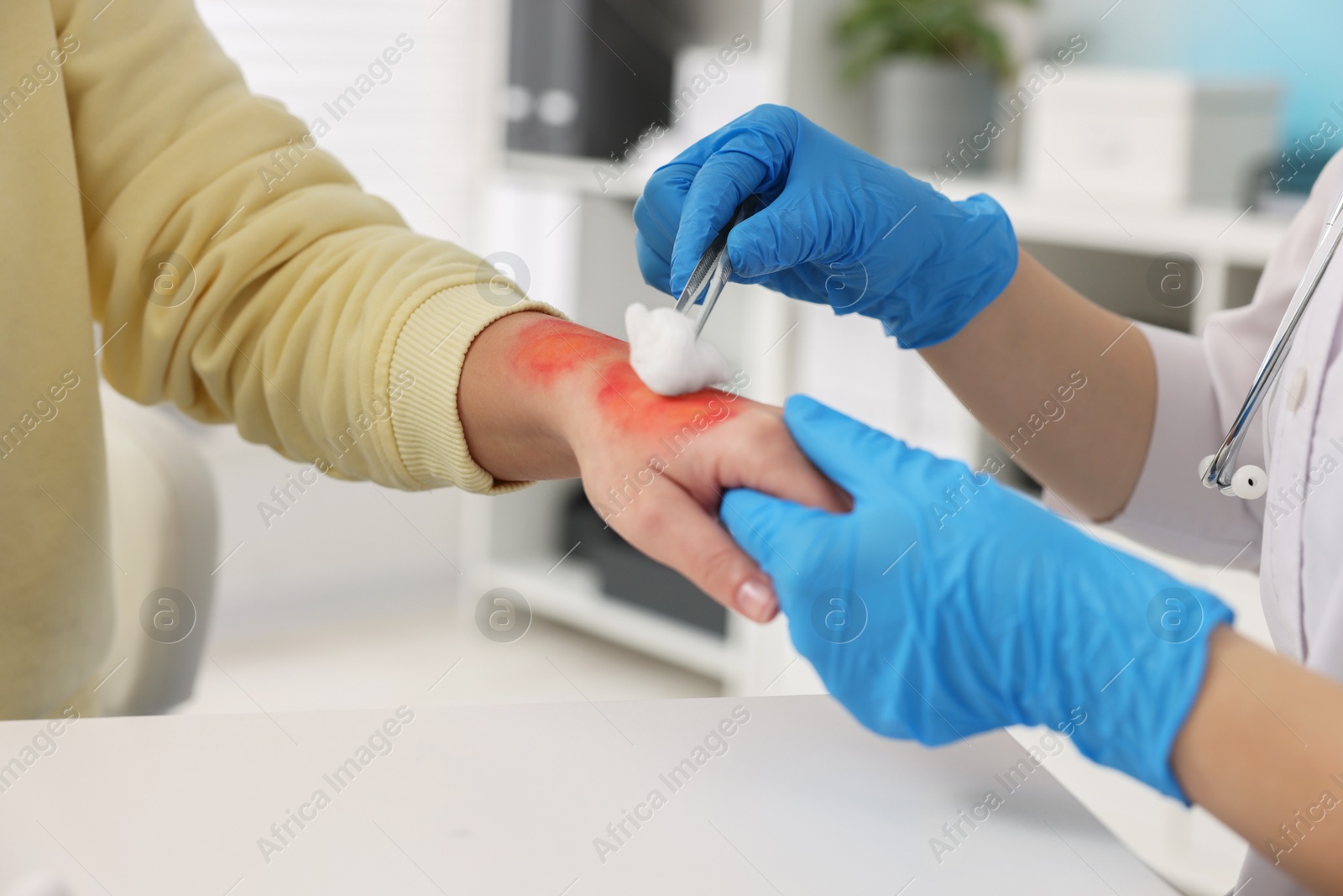 Photo of Doctor treating patient's burned hand in hospital, closeup