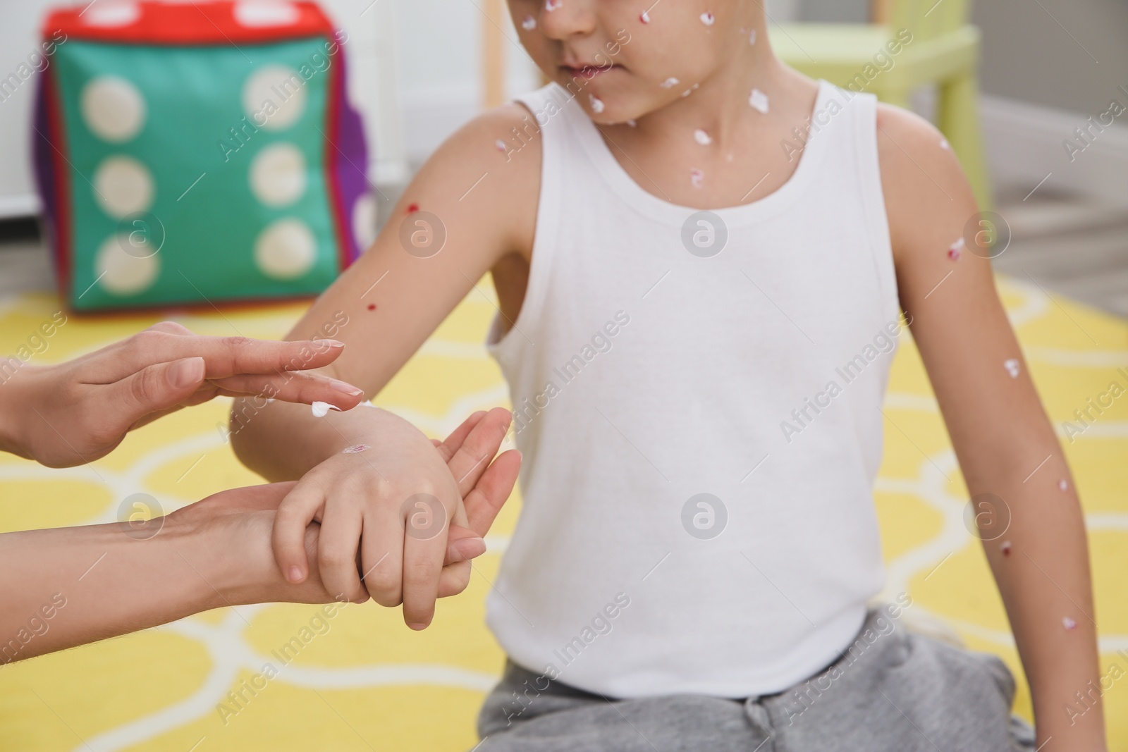 Photo of Woman applying cream onto skin of little boy with chickenpox at home, closeup