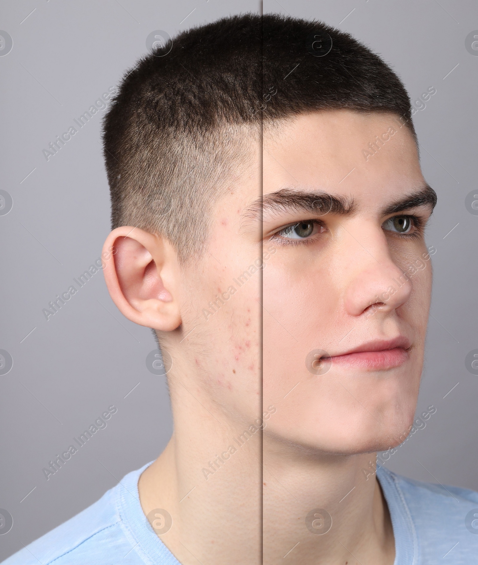 Image of Acne problem, collage. Photo of man divided into halves before and after treatment on grey background