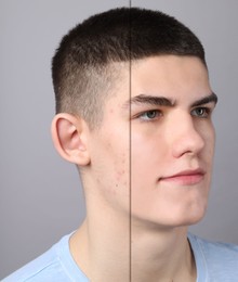 Image of Acne problem, collage. Photo of man divided into halves before and after treatment on grey background