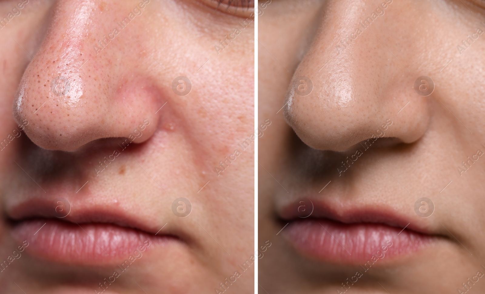 Image of Blackhead treatment, before and after. Collage with photos of woman, closeup view