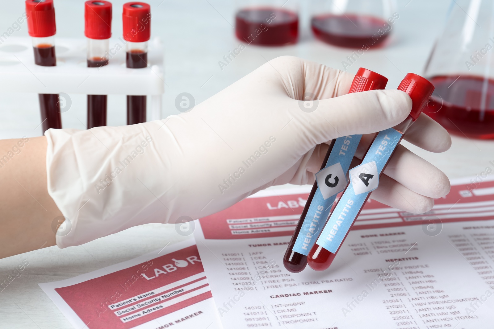 Photo of Scientist holding tubes with blood samples for hepatitis virus test near laboratory form, closeup