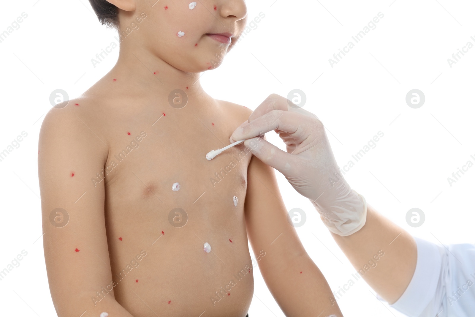 Photo of Doctor applying cream onto skin of little boy with chickenpox against white background, closeup. Varicella zoster virus