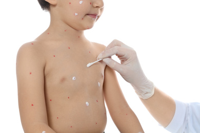 Photo of Doctor applying cream onto skin of little boy with chickenpox against white background, closeup. Varicella zoster virus