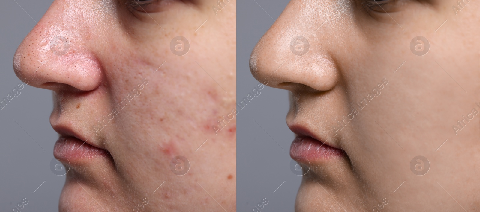 Image of Blackhead treatment, before and after. Collage with photos of woman on grey background, closeup view