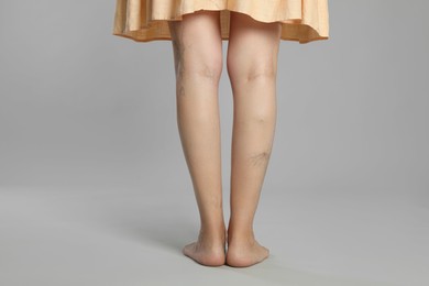 Photo of Closeup view of woman with varicose veins on light grey background