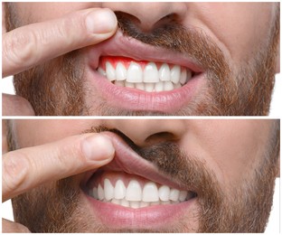 Image of Man showing gum before and after treatment, collage of photos