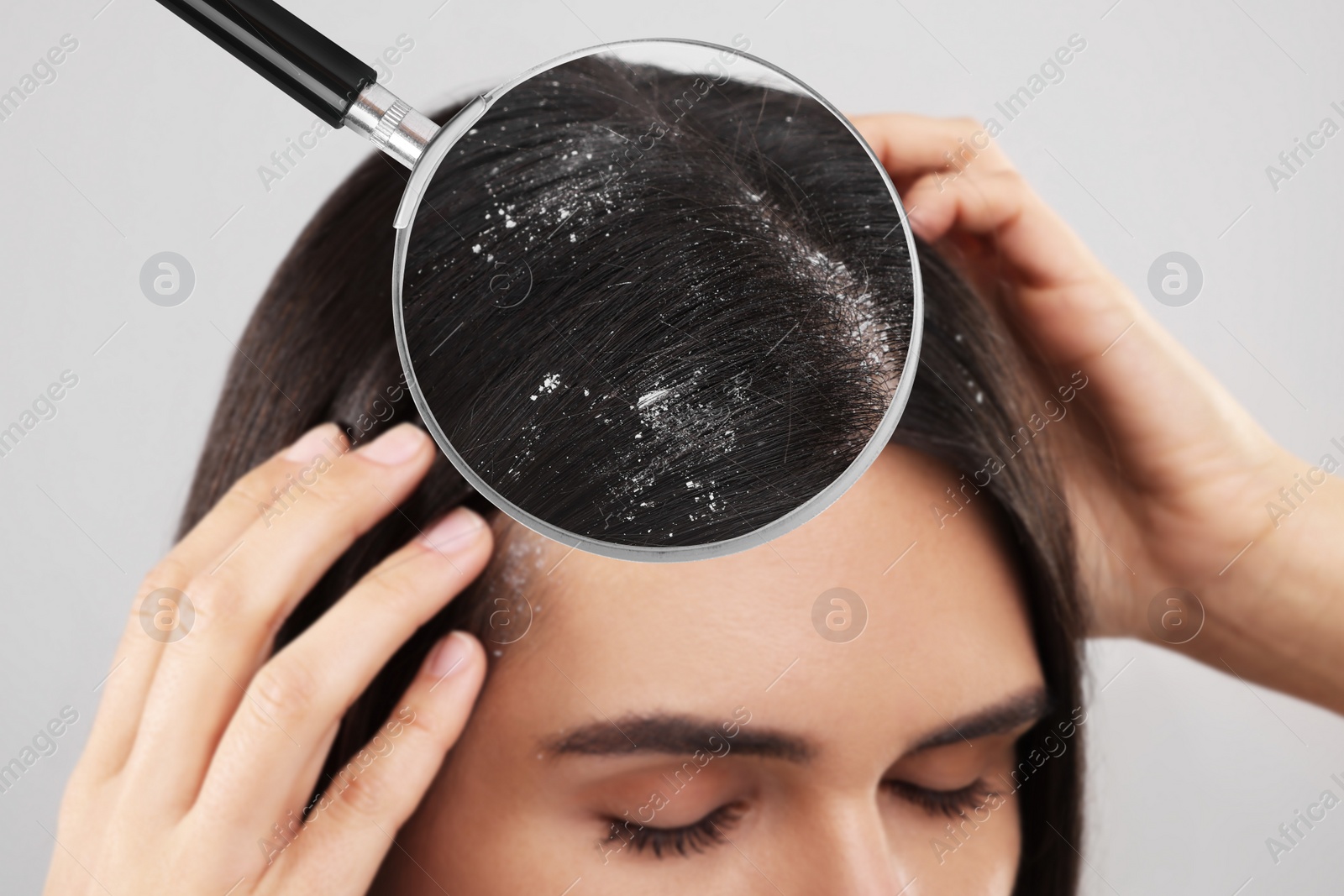 Image of Woman suffering from dandruff on light grey background, closeup. View through magnifying glass on hair with flakes