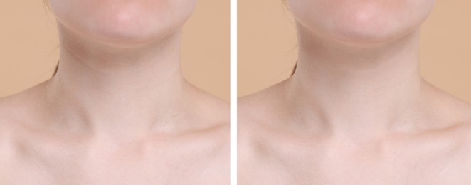 Aging skin changes. Woman showing neck before and after rejuvenation, closeup. Collage comparing skin condition