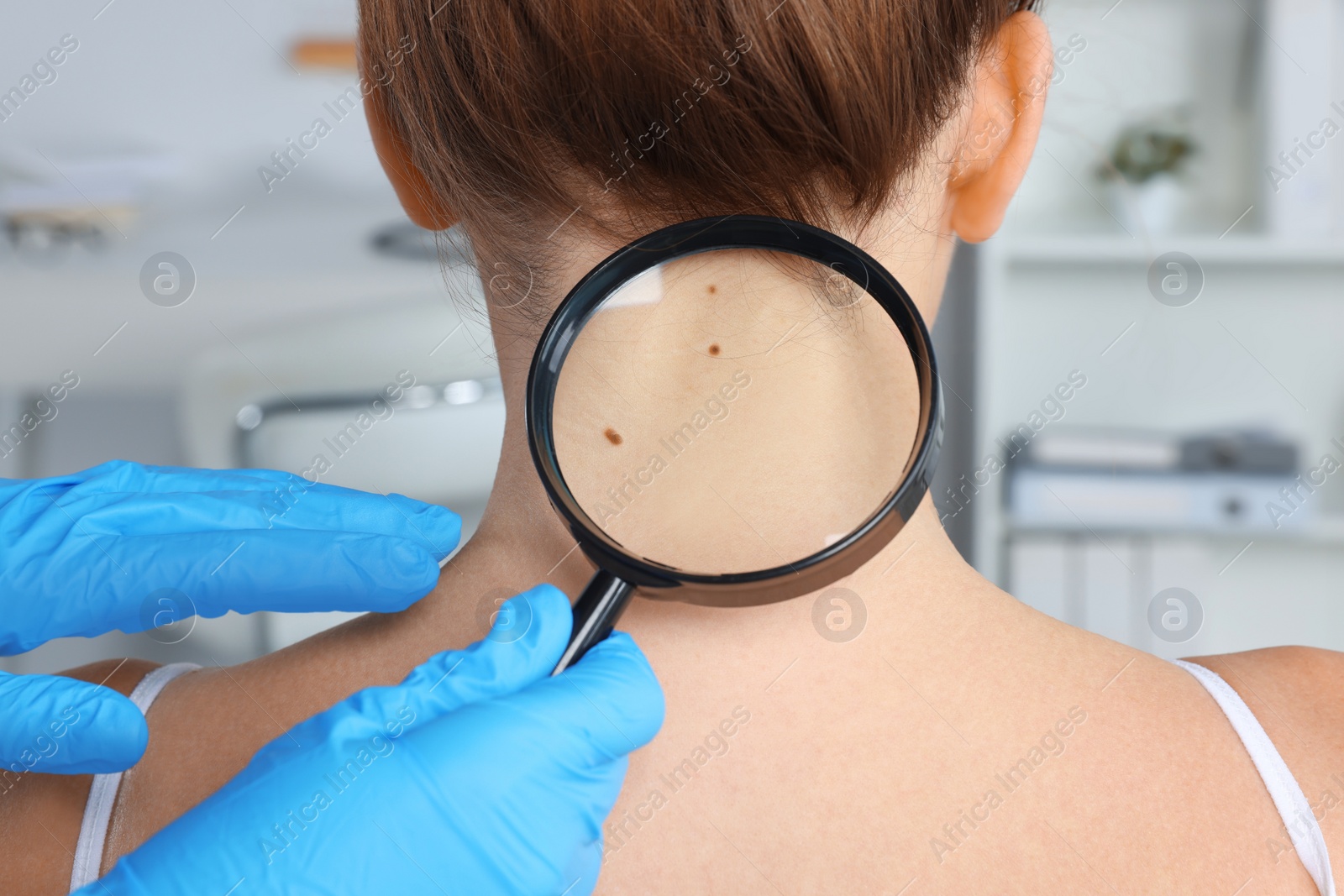 Photo of Dermatologist examining patient's birthmark with magnifying glass in clinic, closeup