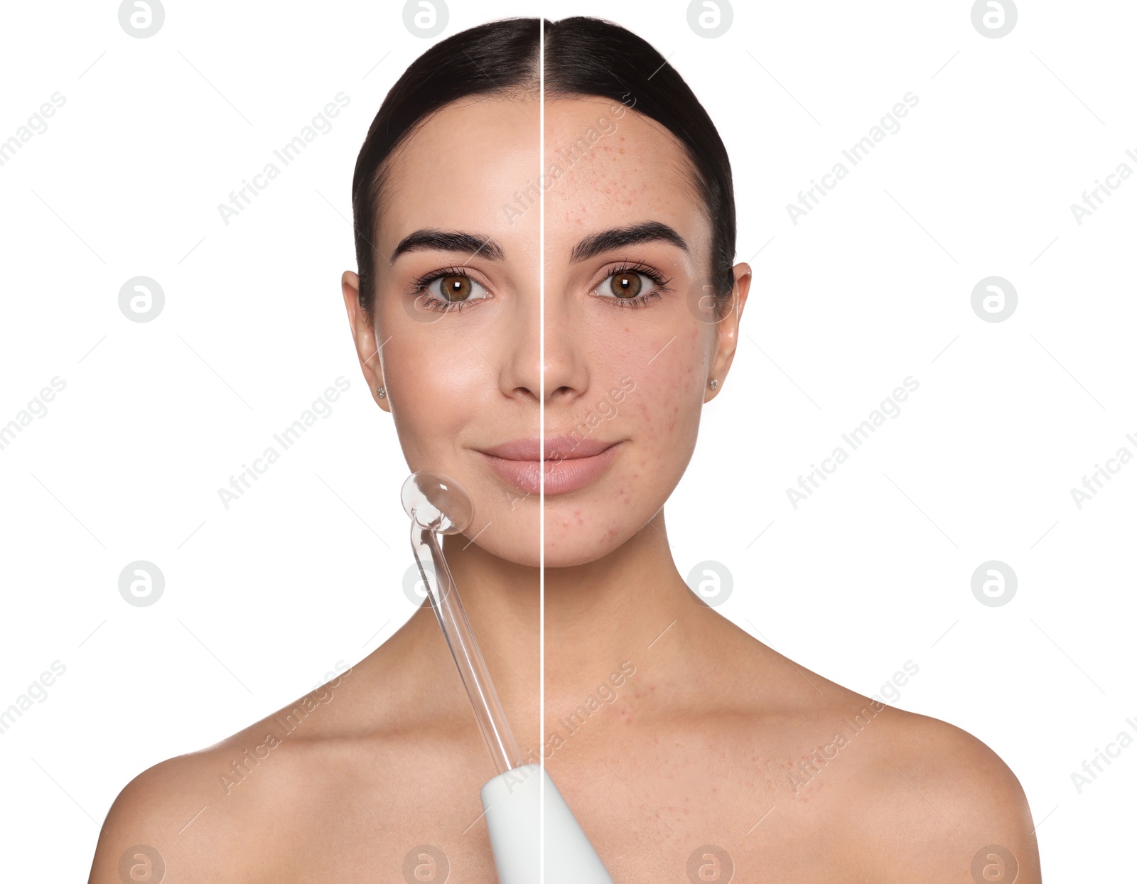 Image of Collage with photos of young woman before and after using darsonval on white background, closeup