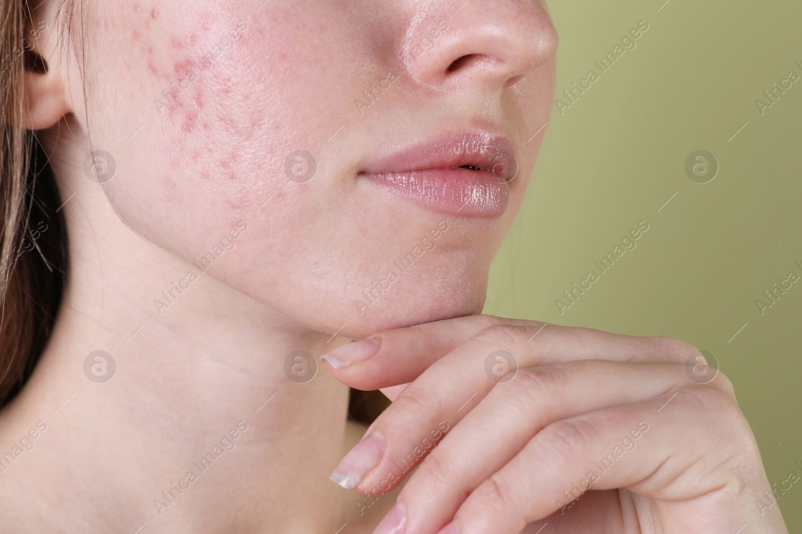 Photo of Young woman with acne problem on olive background, closeup