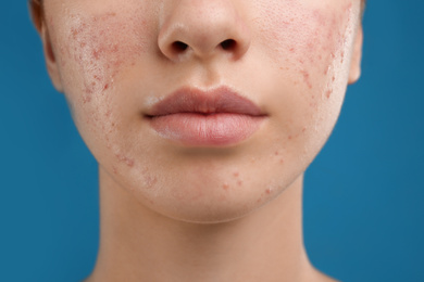 Photo of Teenage girl with acne problem on blue background, closeup