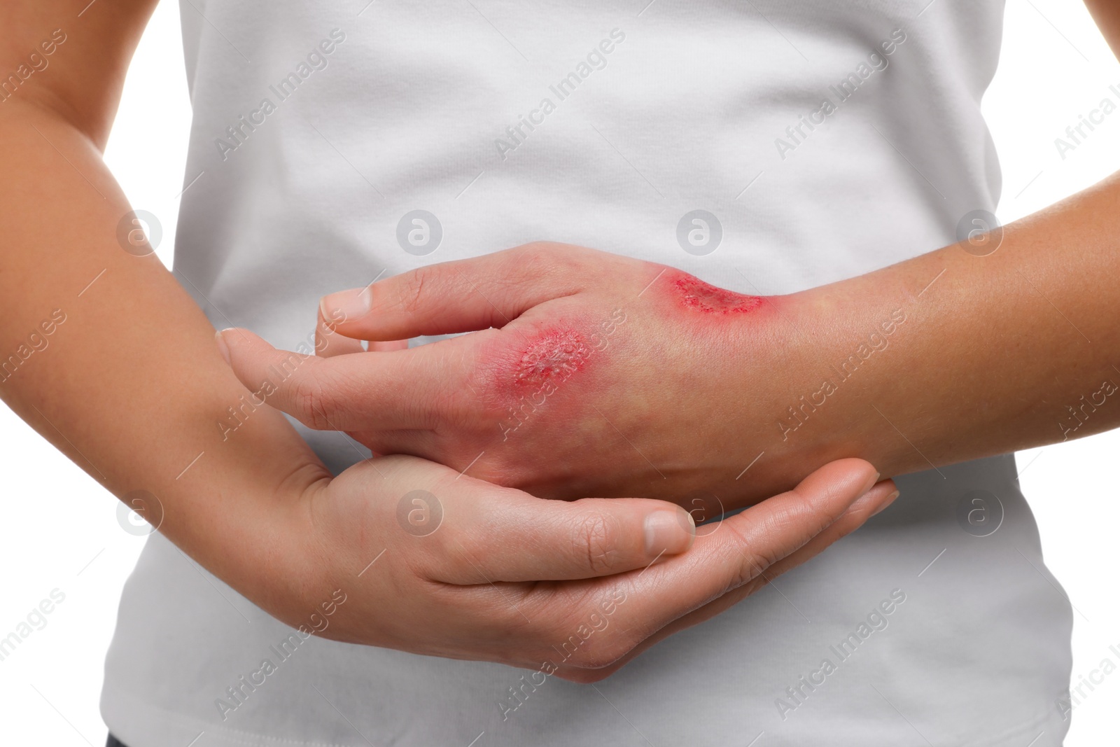 Photo of Woman with burned hand on white background, closeup