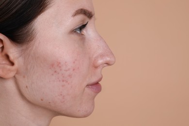 Young woman with acne problem on beige background, closeup. Space for text