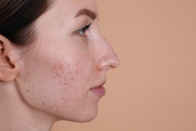 Photo of Young woman with acne problem on beige background, closeup. Space for text