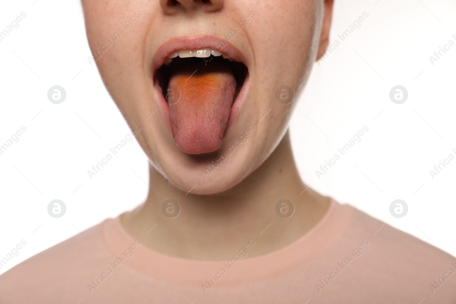 Photo of Gastrointestinal diseases. Woman showing her yellow tongue on white background, closeup