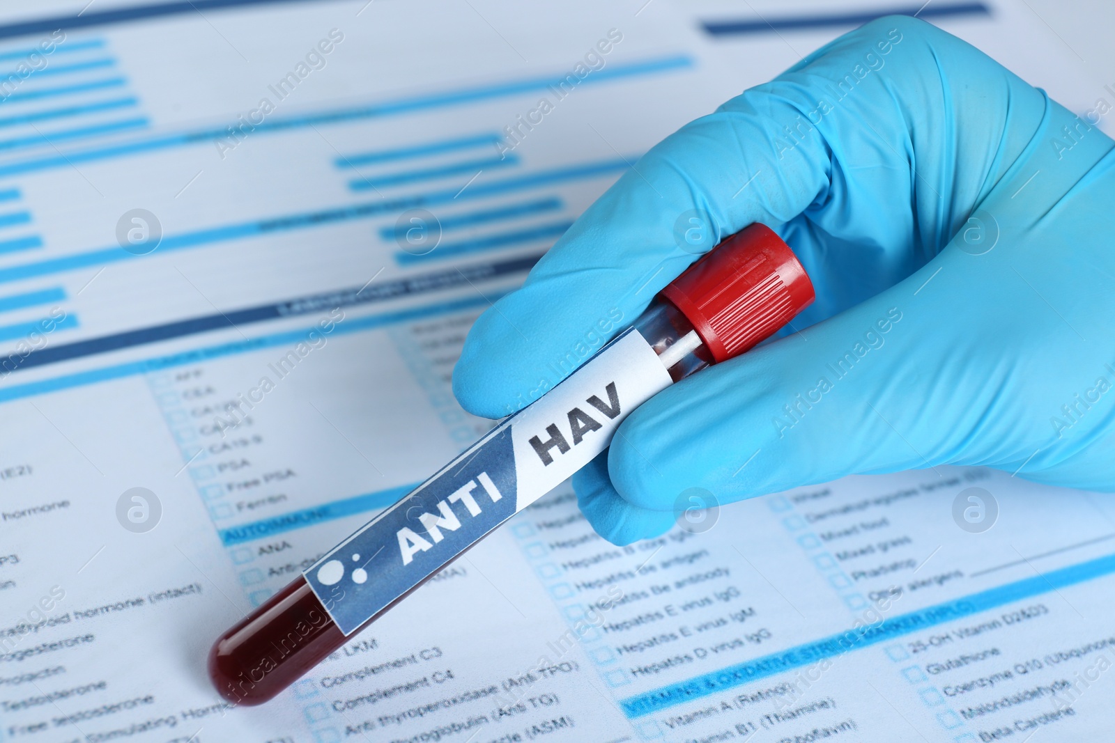 Photo of Scientist holding tube with blood sample and label Anti HAV against laboratory test form, closeup