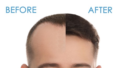 Image of Closeup view of man before and after hair loss treatment on white background, collage. Banner design