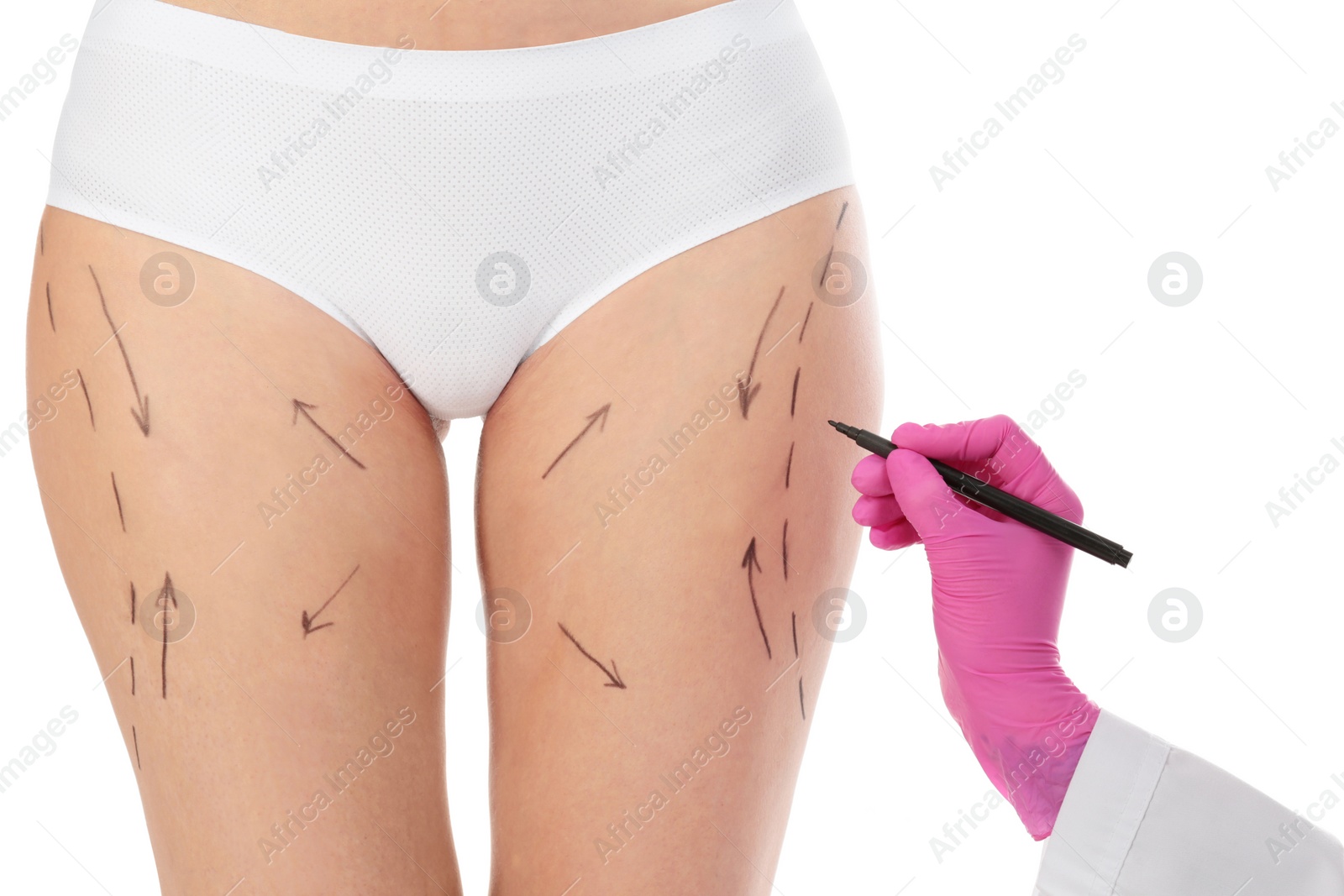 Photo of Doctor drawing marks on woman's body isolated on white. Cosmetic surgery