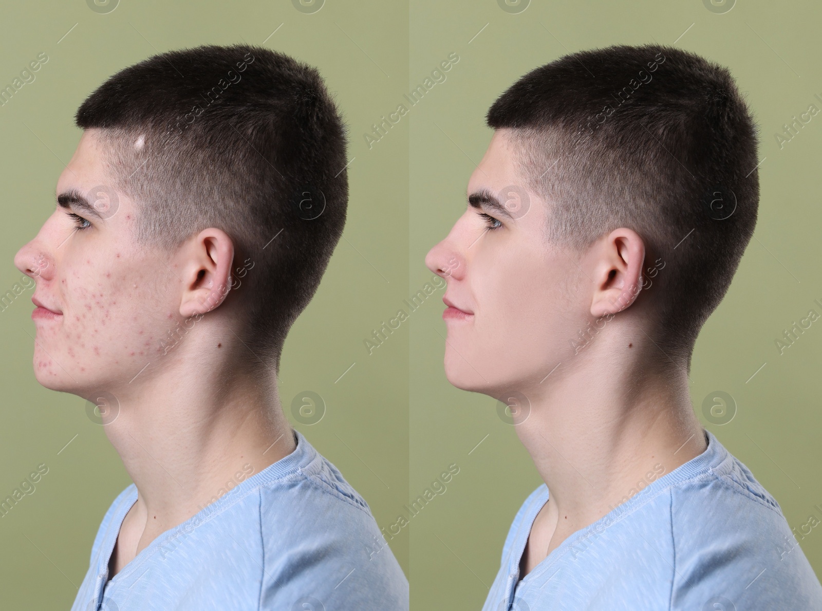 Image of Acne problem. Young man before and after treatment on green background, collage of photos