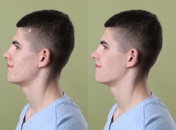 Acne problem. Young man before and after treatment on green background, collage of photos