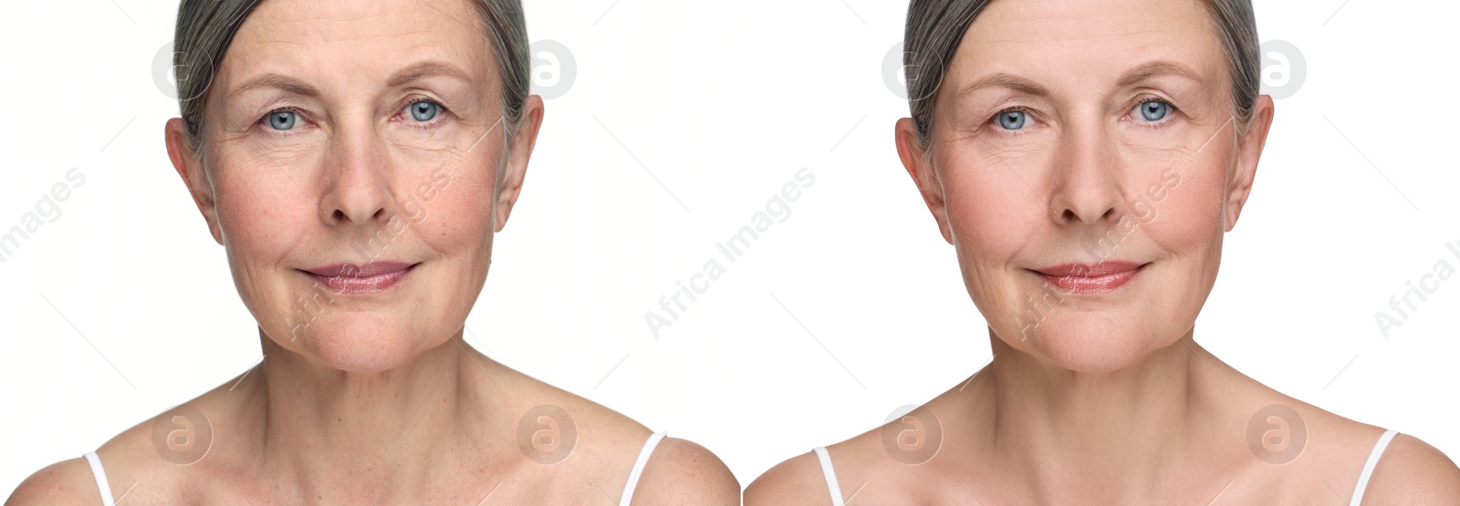 Image of Aging skin changes. Collage with photos of mature woman before and after cosmetic procedure on white background
