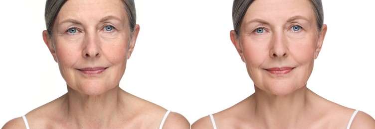 Aging skin changes. Collage with photos of mature woman before and after cosmetic procedure on white background