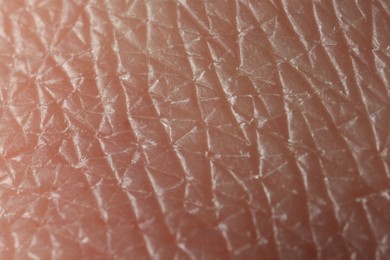 Photo of Texture of dry skin as background, macro view