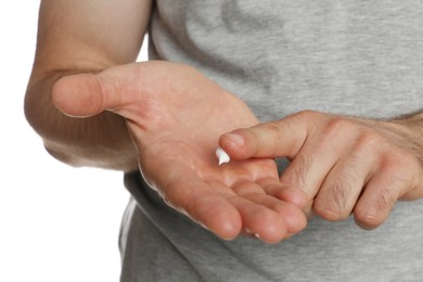 Man applying cream on hand for calluses treatment against white background, closeup