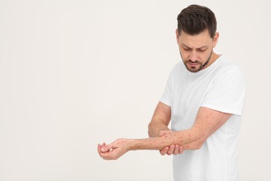 Man with rash suffering from monkeypox virus on beige background. Space for text