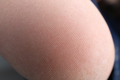 Woman with dry skin on foot, closeup