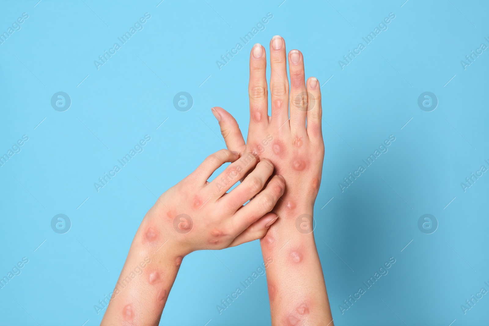 Photo of Woman with rash suffering from monkeypox virus on light blue background, closeup