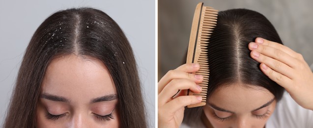 Woman showing hair before and after dandruff treatment, collage