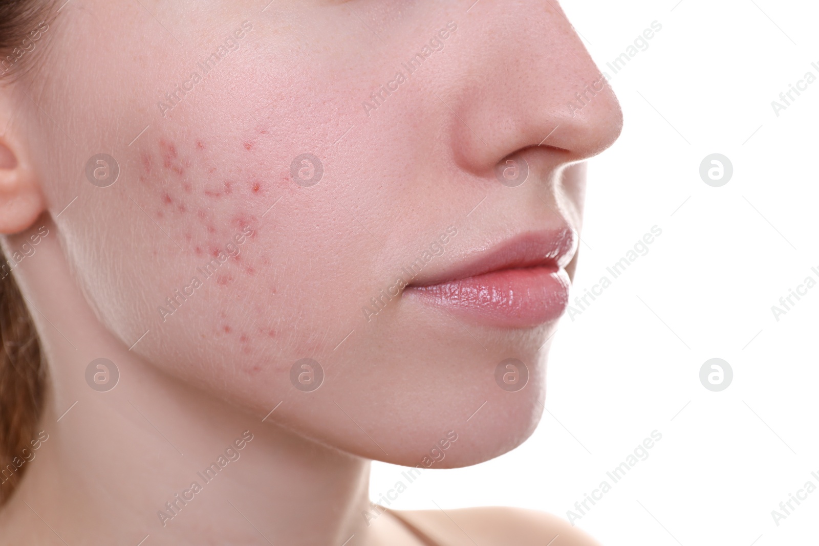 Photo of Young woman with acne problem on white background, closeup