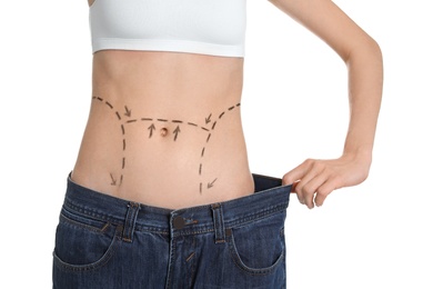 Young woman with marks on belly in big jeans after cosmetic surgery operation against white background