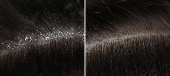 Man showing hair before and after dandruff treatment, collage