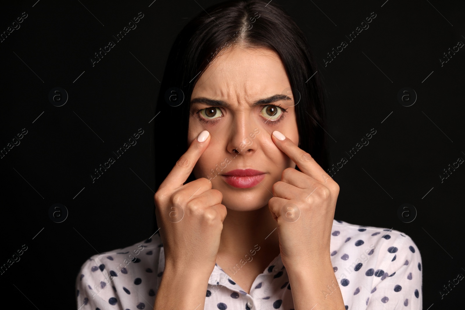 Photo of Woman checking her health condition on black background. Yellow eyes as symptom of problems with liver