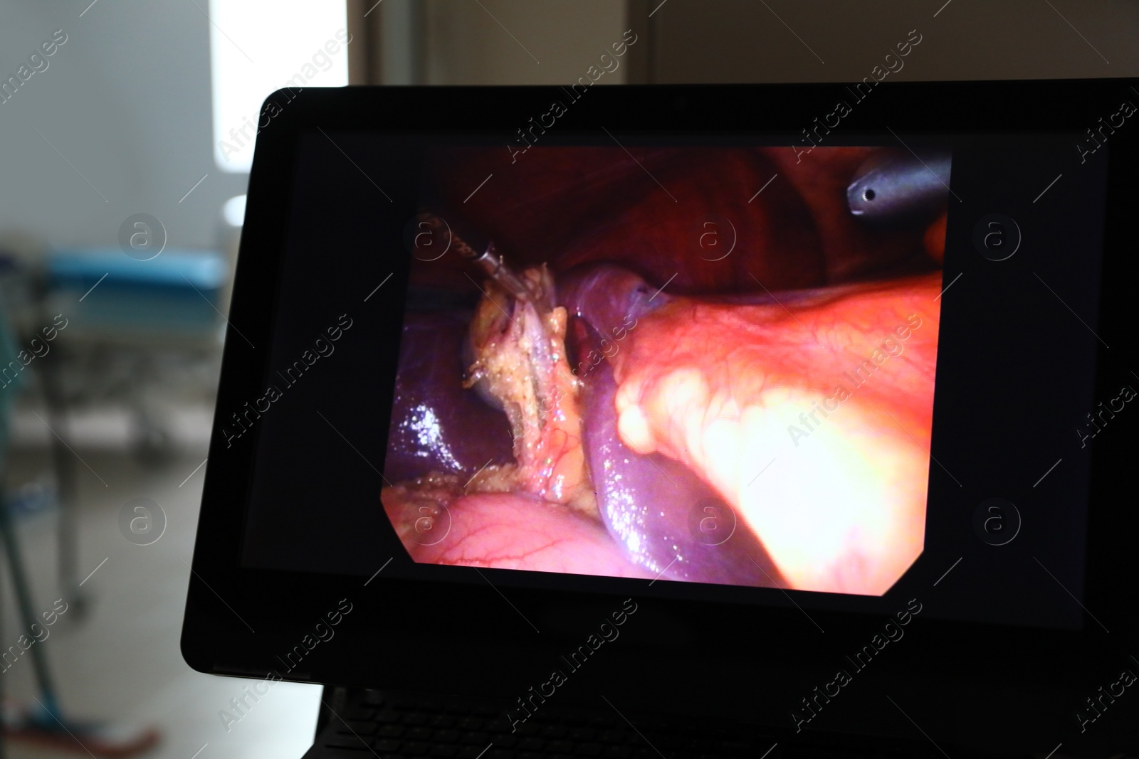 Photo of Displaying process of surgery on monitor in operating room