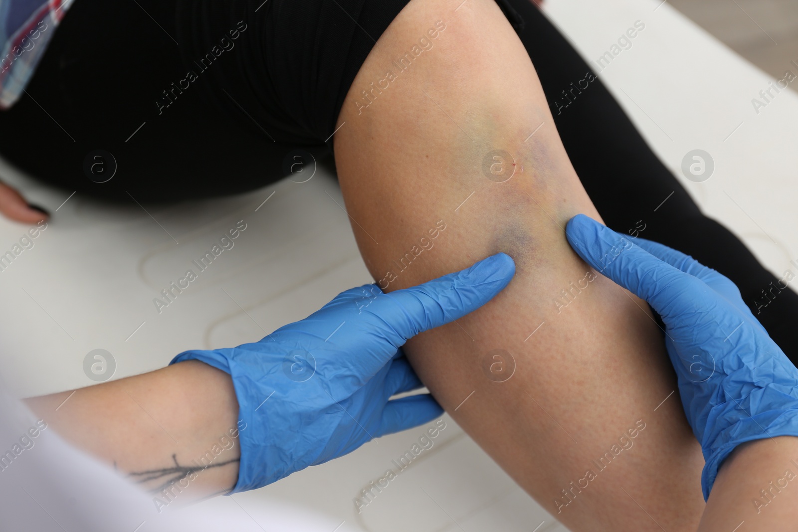 Photo of Doctor checking boy's leg with bruise at hospital, closeup