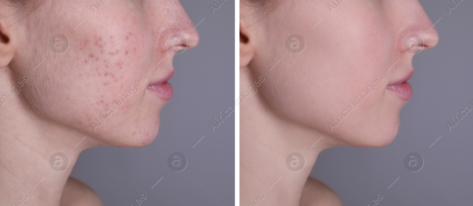 Image of Acne problem. Young woman before and after treatment on grey background, closeup. Collage of photos