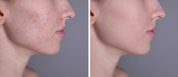 Acne problem. Young woman before and after treatment on grey background, closeup. Collage of photos