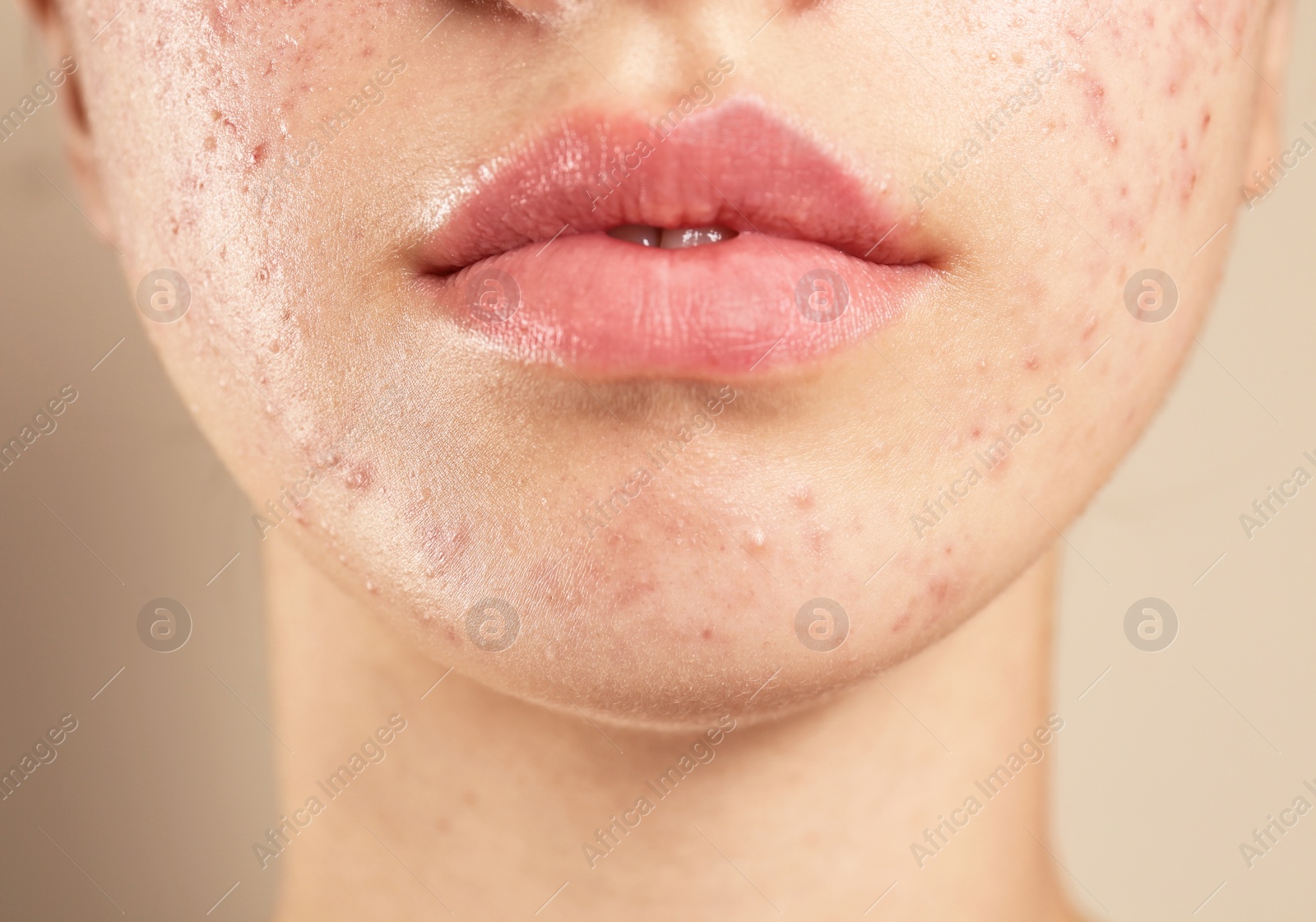 Photo of Teenage girl with acne problem on beige background, closeup