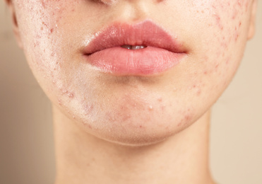 Photo of Teenage girl with acne problem on beige background, closeup