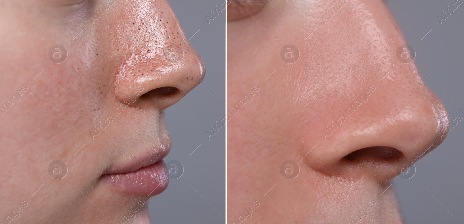 Image of Blackhead treatment, before and after. Collage with photos of woman on grey background, closeup view