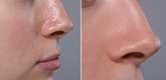 Blackhead treatment, before and after. Collage with photos of woman on grey background, closeup view